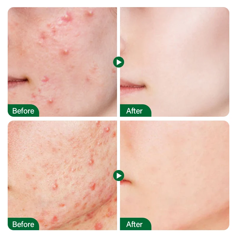 FORT Salicylic Acid Face Serum – Acne & Dark Spot Removal