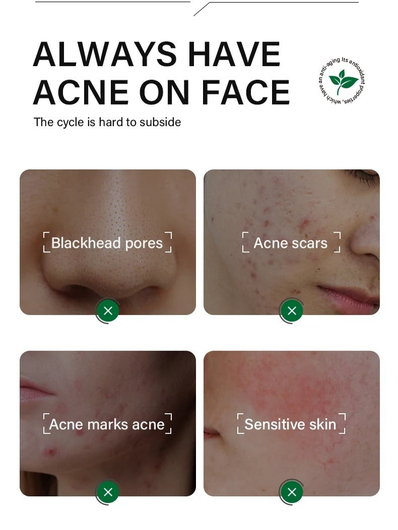 FORT Salicylic Acid Face Serum – Acne & Dark Spot Removal