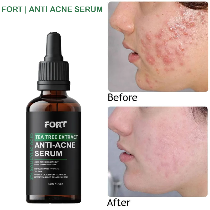 FORT Salicylic Acid Face Serum – Acne & Dark Spot Removal